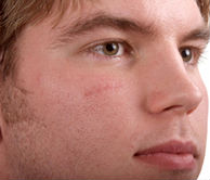 young man with scar on his right cheek 