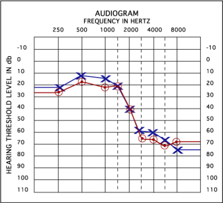 Audiogram  fequency in hertz 